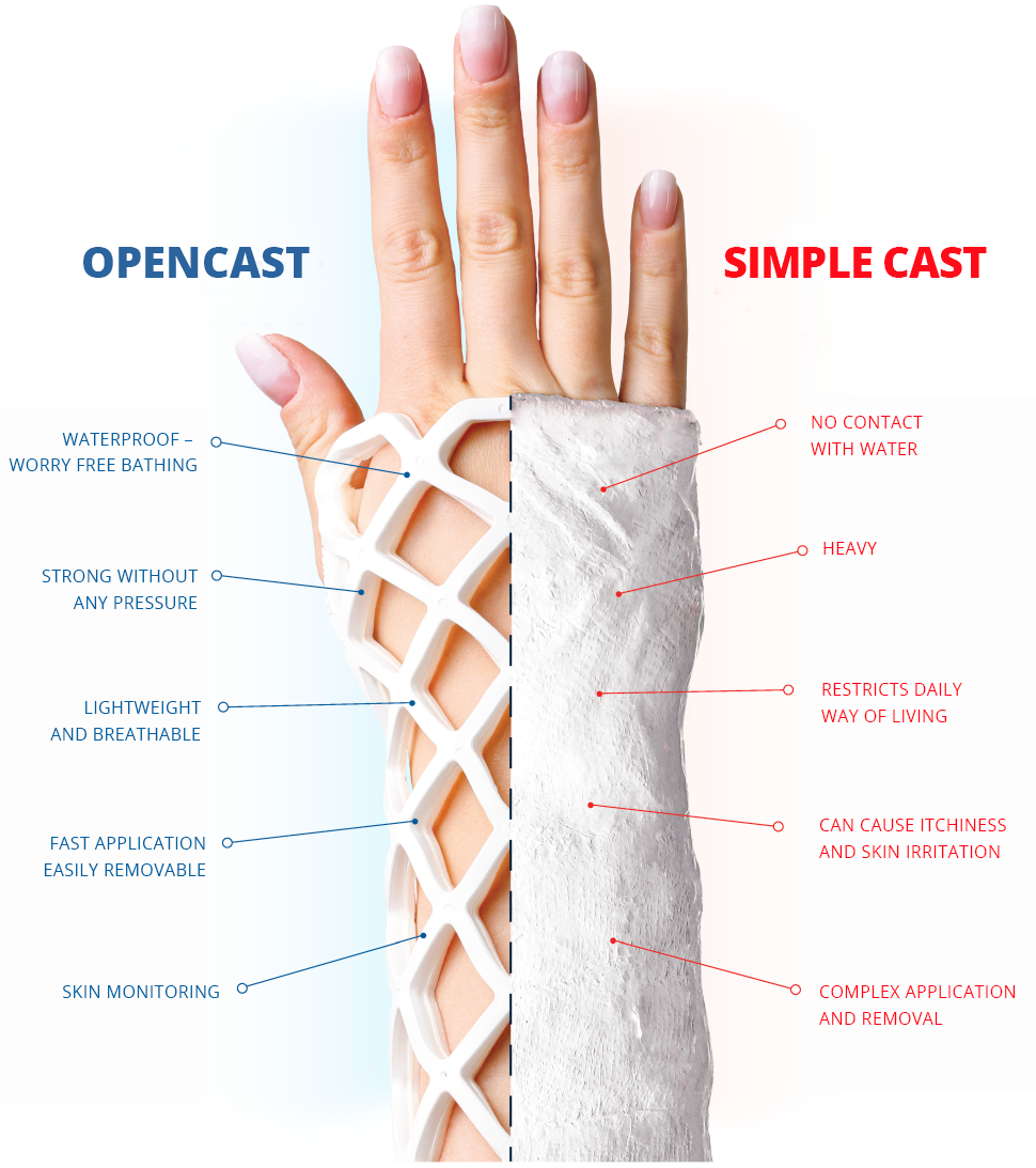 Běžná sádra vs OPEN CAST